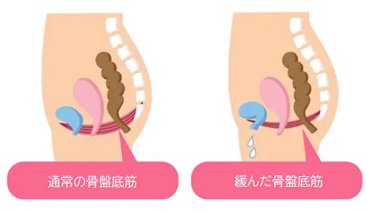 通常骨盤底筋と緩んだ通常骨盤底筋　イメージ